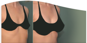 My Breast Reduction (34DDD to B/C) - Review - RealSelf