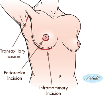 Why are my boobs so wonky? Is there a version of top surgery that doesn't  involve implants and just fix the placement; like the distance between? :  r/trans