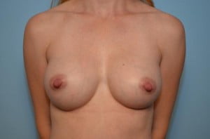 Breast Surgery Breast Augmentation