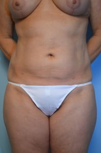 Liposuction Abdomen and Flanks