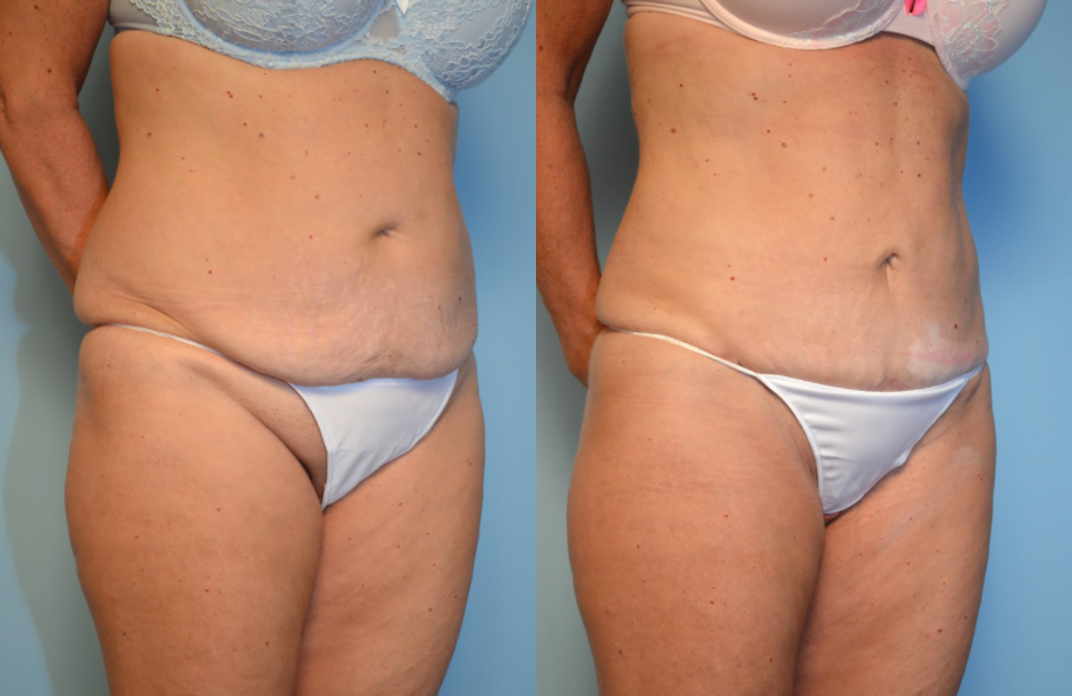 Panniculectomy Vs. Abdominoplasty (Tummy Tuck): Understanding the  Difference