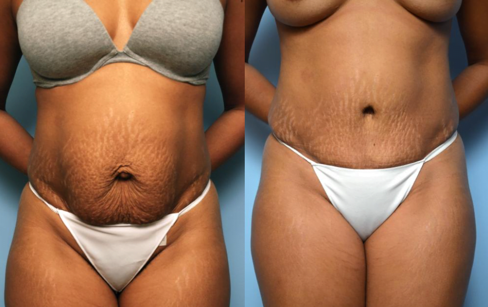 Which Tummy Tuck Is Right for You?